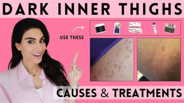 Acne on thighs - How To Discuss