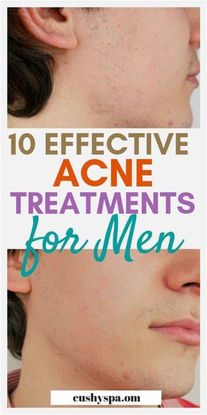 Acne treatment for men - How To Discuss