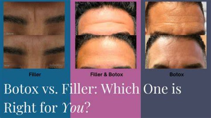 Botox and fillers - How To Discuss