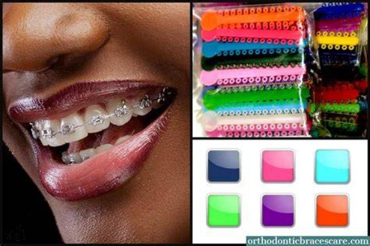 Braces Colors For Brown Skin