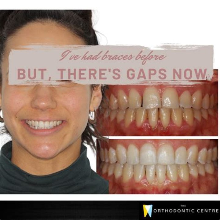 Braces Giving Me A Gap