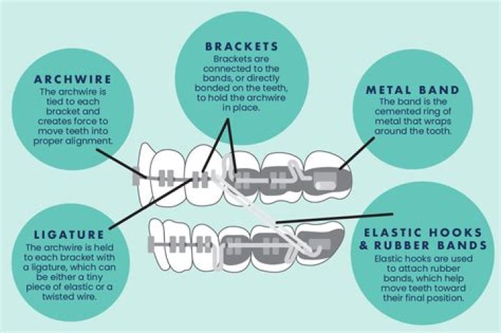 Brackets - How To Discuss