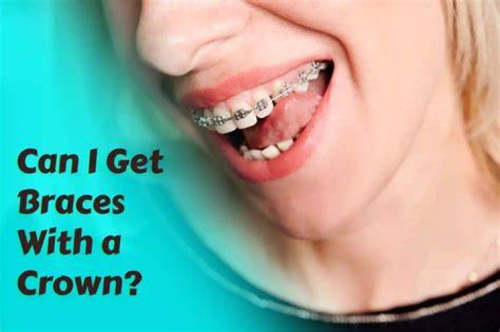 Can I Get Braces With A Crown