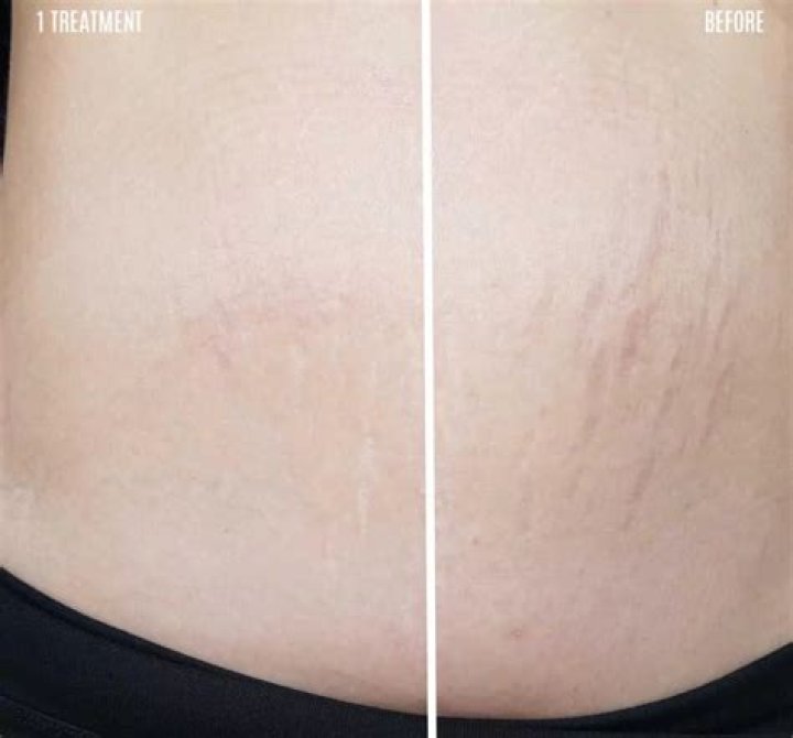 Can you get rid of stretch marks