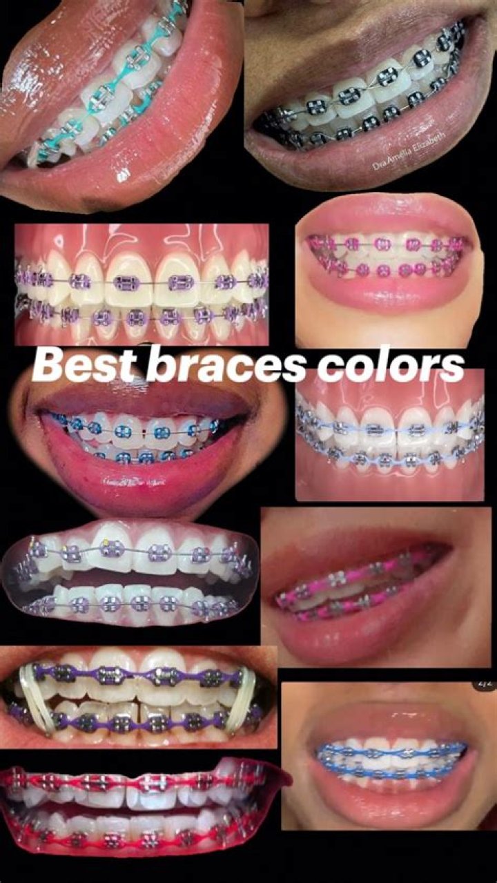 Chain Braces Colors - How To Discuss