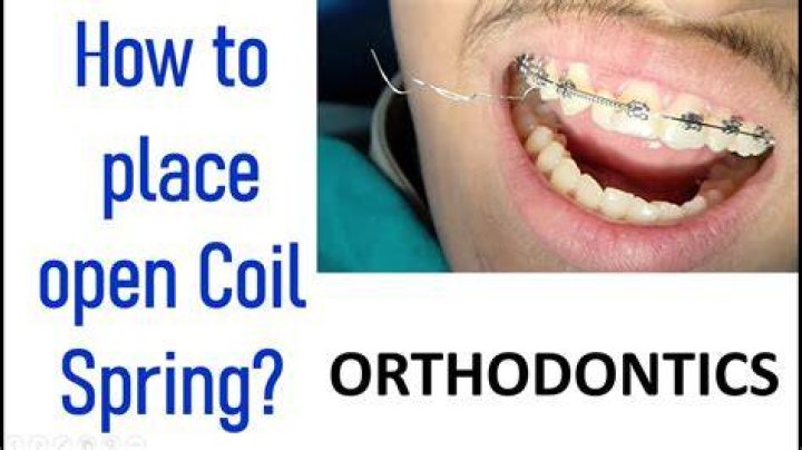 Coil Spring Braces - How To Discuss