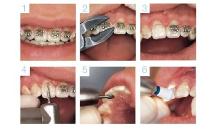 Como Quitar El Pegamento De Los Brackets En Casa