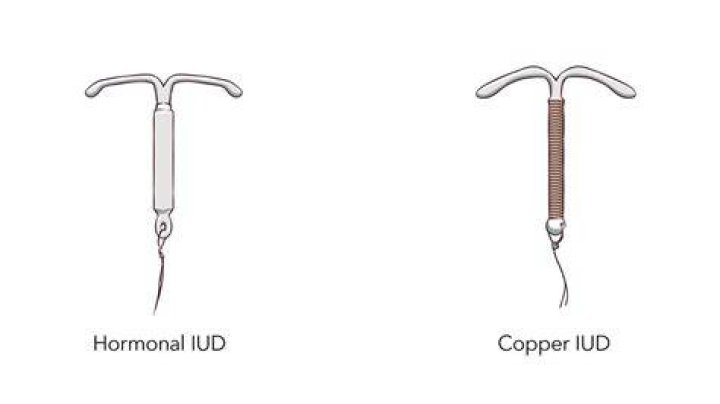 Copper iud vs hormonal iud