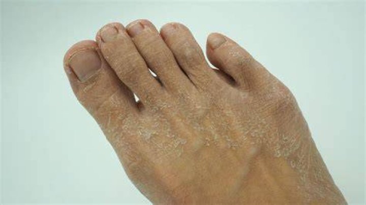 Dry skin on feet - How To Discuss