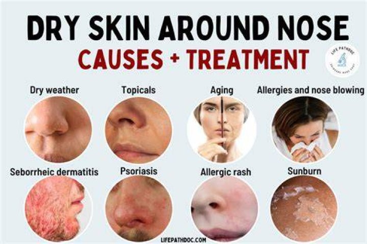 Dry skin on nose - How To Discuss