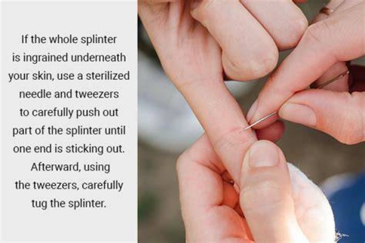 Hair splinter - How To Discuss