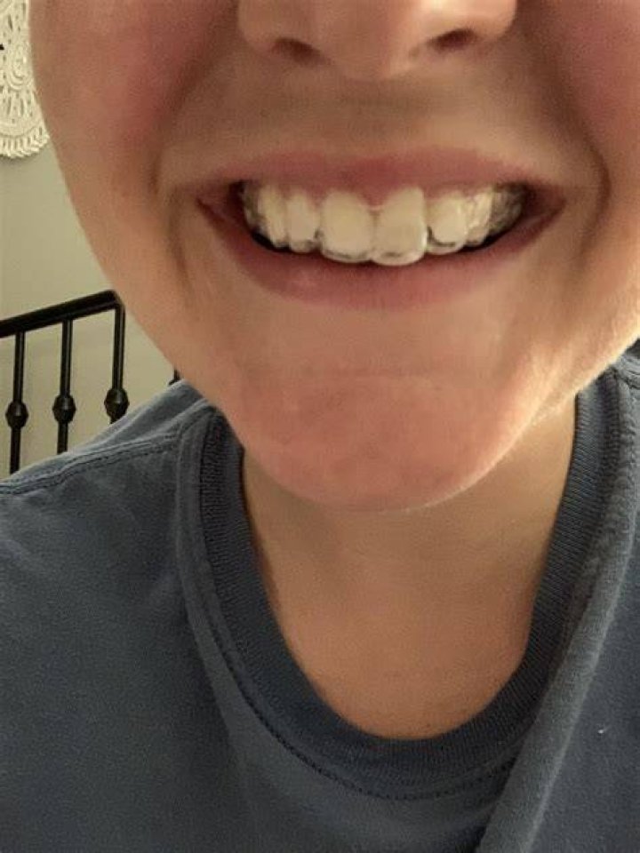 Haven T Worn Retainer In Years