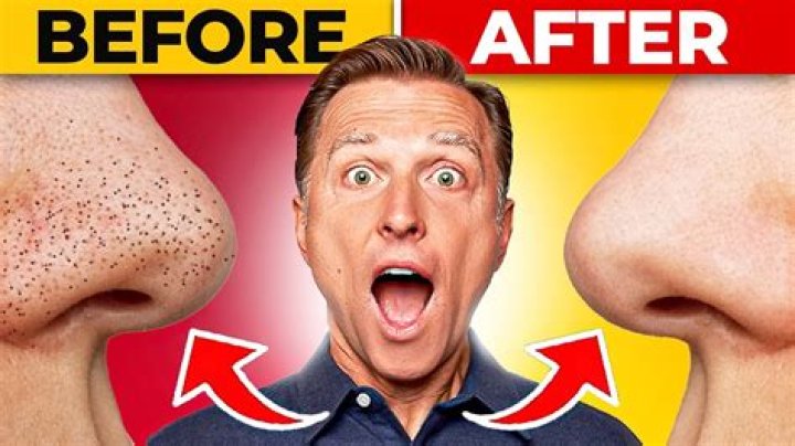 How to clear blackheads - How To Discuss