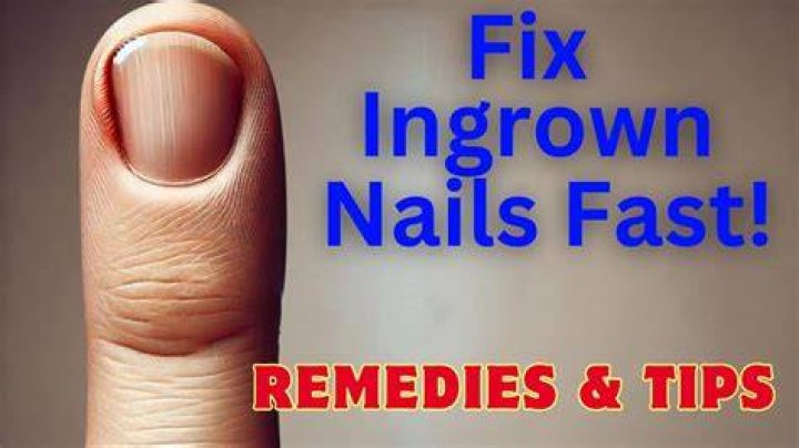 How to get rid of an ingrown fingernail