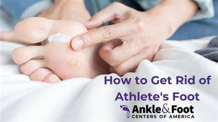 How to get rid of athlete's foot