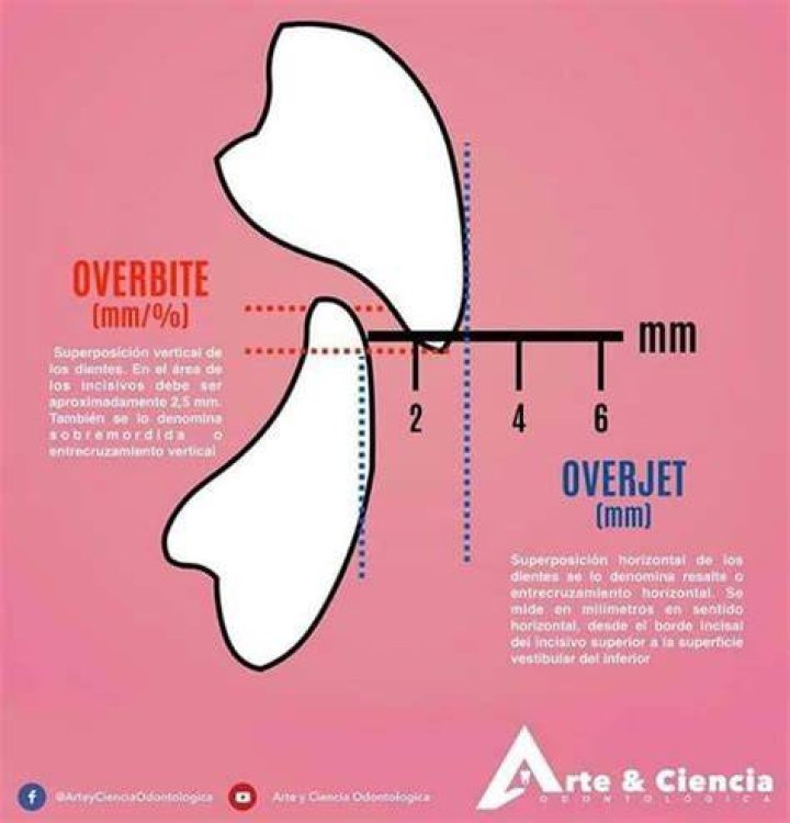 How To Measure Overbite At Home