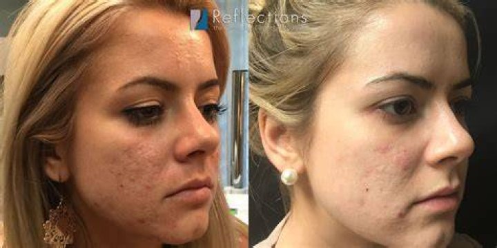 Laser resurfacing acne scars - How To Discuss