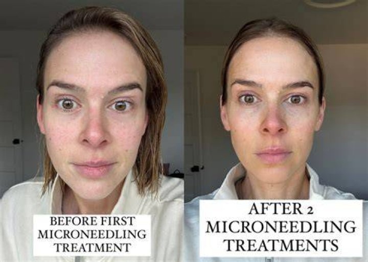 Microneedling reviews - How To Discuss