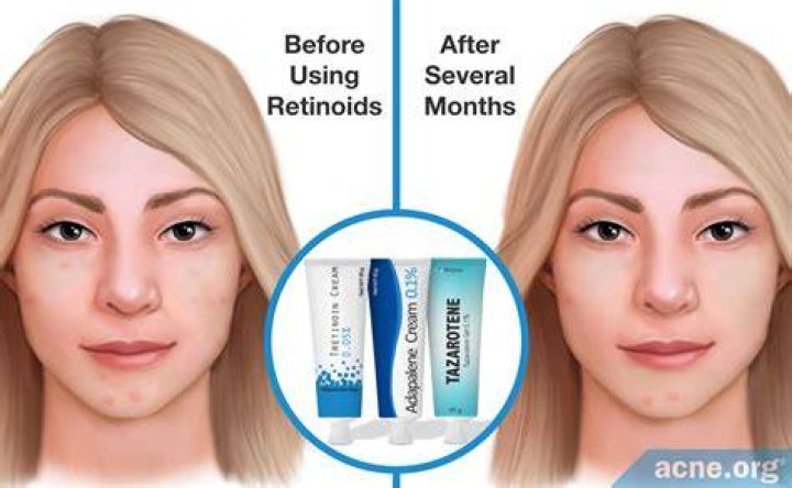 Retinol cream for acne - How To Discuss