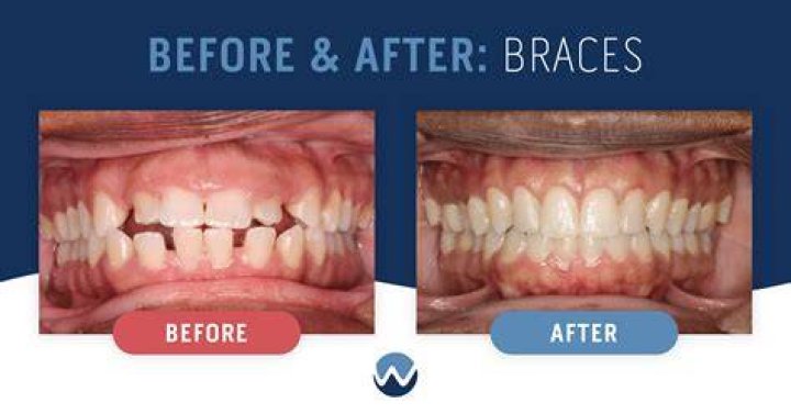 Shortest Time For Braces - How To Discuss