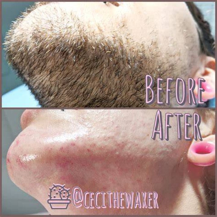 Waxing After Laser Hair Removal