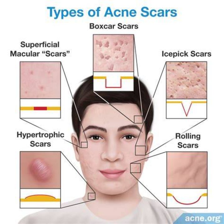 What do acne scars look like