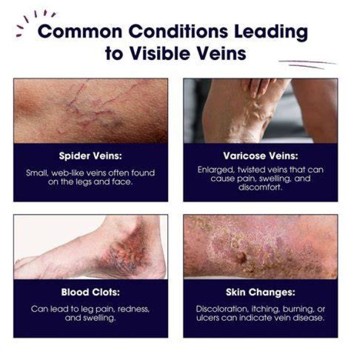 Why Are My Veins So Visible All Of A Sudden