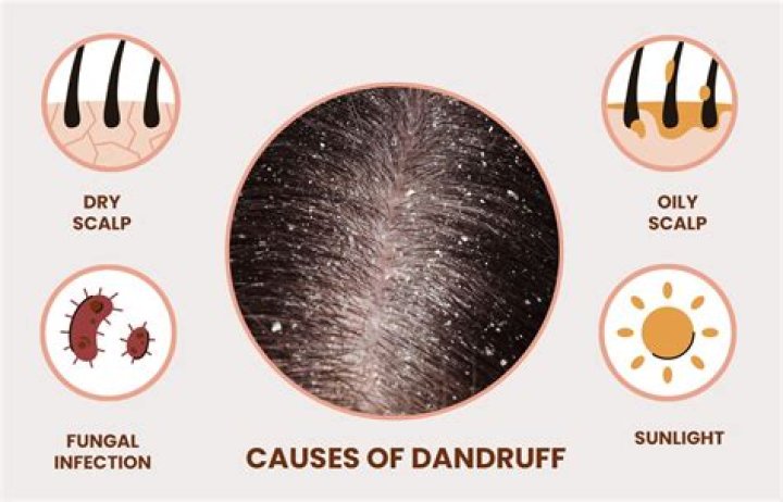 Why do i have so much dandruff